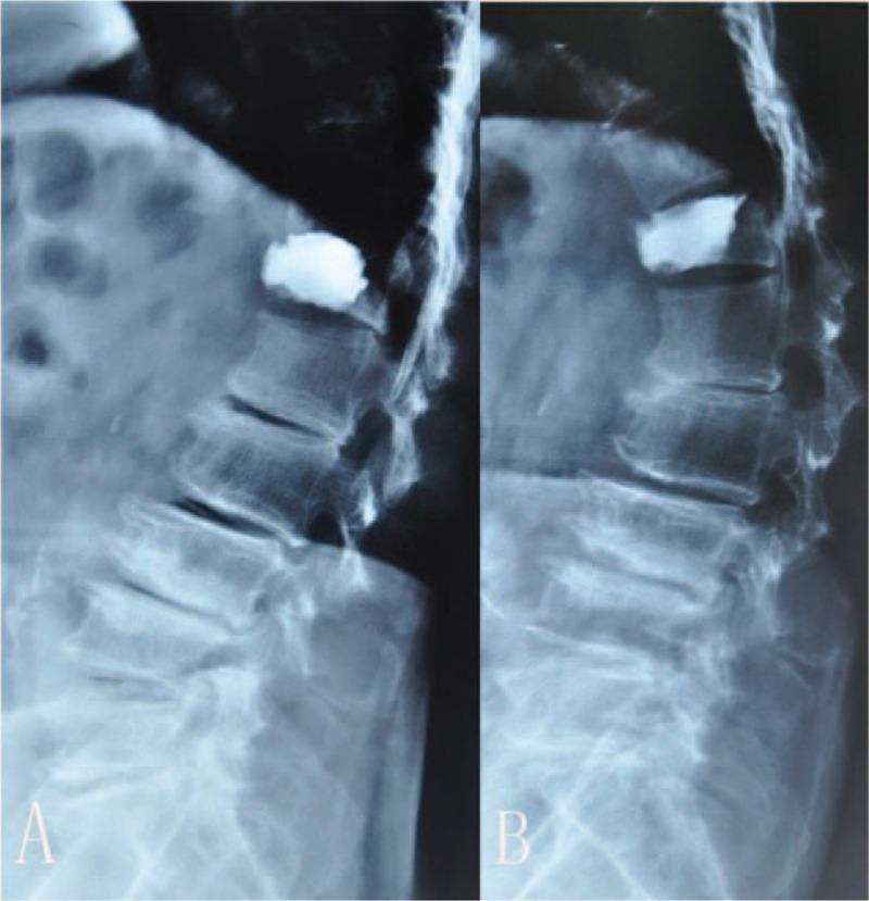 https://cdn.ncbi.nlm.nih.gov/pmc/blobs/c435/5709019/66d1a0cb7bad/medi-96-e8895-g004.jpg