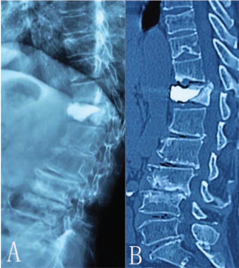 https://cdn.ncbi.nlm.nih.gov/pmc/blobs/c435/5709019/693011d6f7f7/medi-96-e8895-g007.jpg