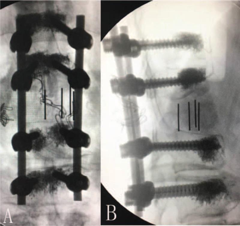 https://cdn.ncbi.nlm.nih.gov/pmc/blobs/c435/5709019/8630acb93145/medi-96-e8895-g009.jpg