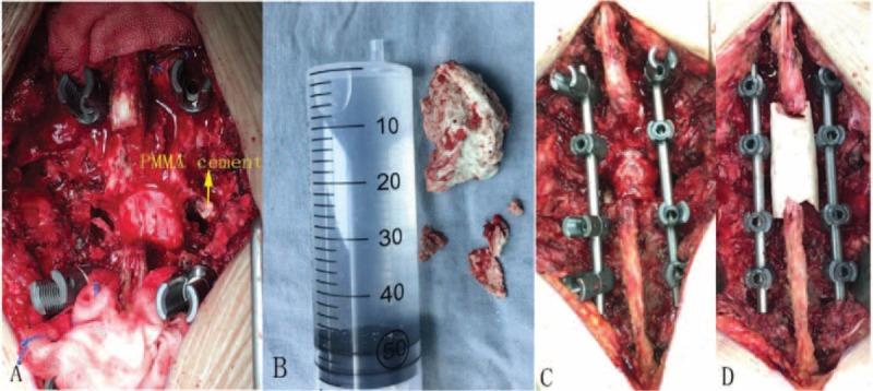 https://cdn.ncbi.nlm.nih.gov/pmc/blobs/c435/5709019/99c937a9b8db/medi-96-e8895-g008.jpg