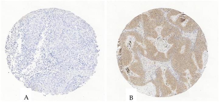 https://cdn.ncbi.nlm.nih.gov/pmc/blobs/c455/11987875/253bb5adddce/cancers-17-01142-g004.jpg