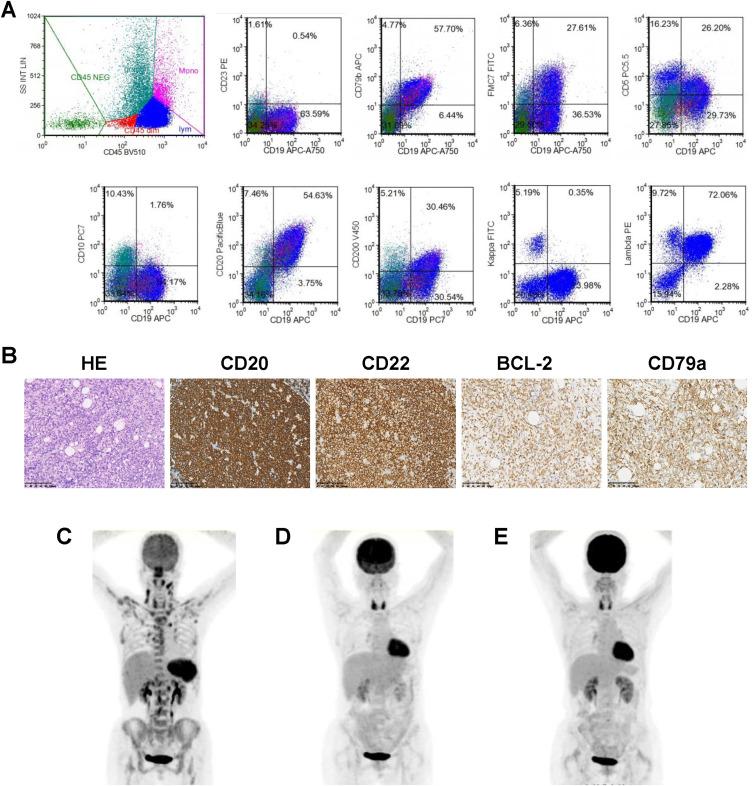 https://cdn.ncbi.nlm.nih.gov/pmc/blobs/c4ef/12275916/98477ad2f387/CMAR-17-1389-g0001.jpg