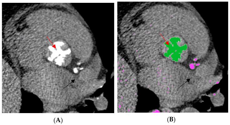 https://cdn.ncbi.nlm.nih.gov/pmc/blobs/c507/11051576/9588e21a3e89/jcm-13-02386-g001.jpg