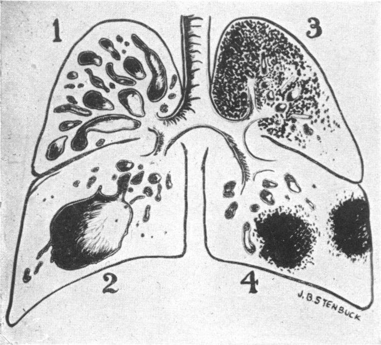 https://cdn.ncbi.nlm.nih.gov/pmc/blobs/c52b/1399898/450843c48e1e/annsurg00714-0044-a.jpg