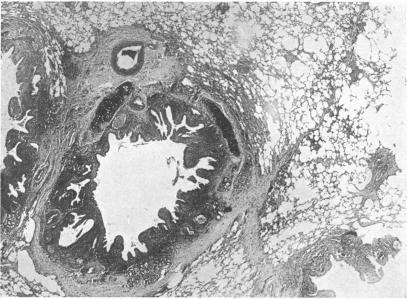 https://cdn.ncbi.nlm.nih.gov/pmc/blobs/c52b/1399898/7ceeaf63bf90/annsurg00714-0045-a.jpg