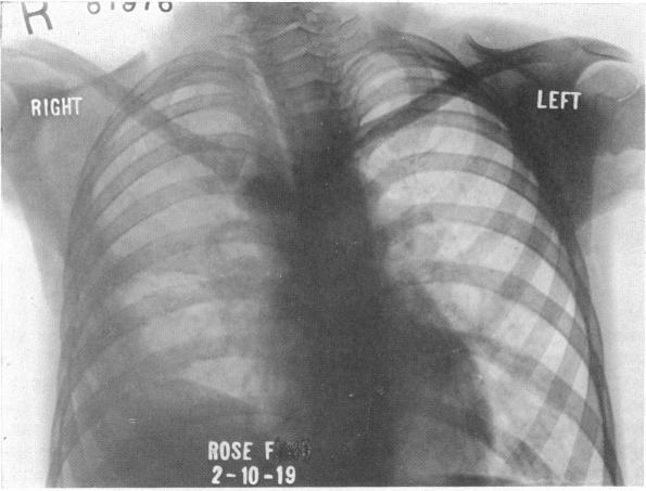 https://cdn.ncbi.nlm.nih.gov/pmc/blobs/c52b/1399898/87f34d7b283e/annsurg00714-0029-b.jpg