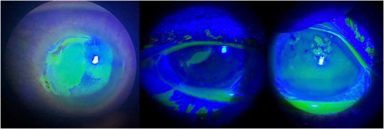 https://cdn.ncbi.nlm.nih.gov/pmc/blobs/c557/12124201/89fdf055a89c/cornea-44-886-g003.jpg
