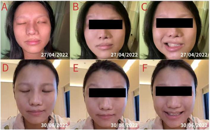 https://cdn.ncbi.nlm.nih.gov/pmc/blobs/c55f/9845618/482da047d3a1/fneur-13-1088138-g0002.jpg