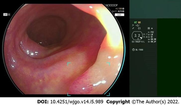https://cdn.ncbi.nlm.nih.gov/pmc/blobs/c5a3/9124983/062363a1e956/WJGO-14-989-g001.jpg