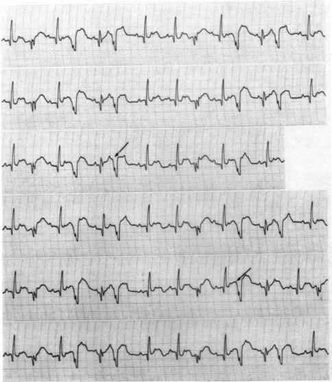 https://cdn.ncbi.nlm.nih.gov/pmc/blobs/c5ac/487514/383a595a640c/brheartj00315-0024-a.jpg