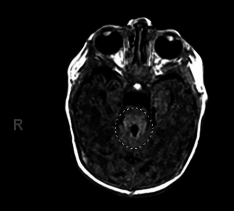 https://cdn.ncbi.nlm.nih.gov/pmc/blobs/c5f0/11386947/6c27d79f2cdf/cureus-0016-00000066648-i01.jpg