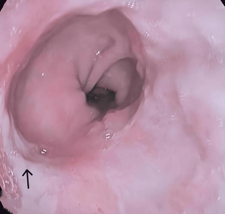 https://cdn.ncbi.nlm.nih.gov/pmc/blobs/c62e/12085907/f2d2b3db93a6/cureus-0017-00000082522-i03.jpg
