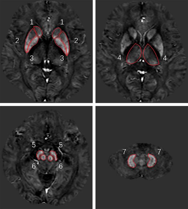 https://cdn.ncbi.nlm.nih.gov/pmc/blobs/c641/11710887/1814fd09d573/BRB3-15-e70240-g003.jpg