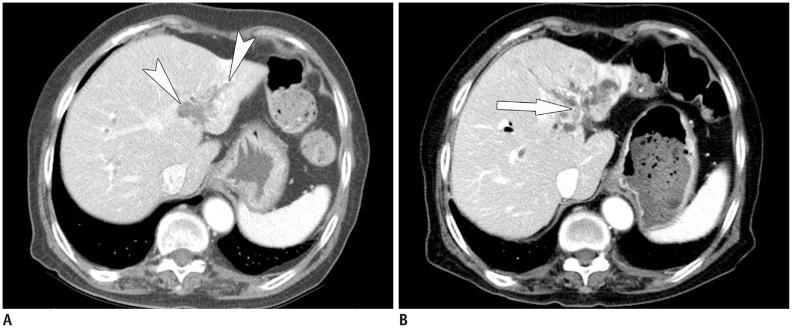 https://cdn.ncbi.nlm.nih.gov/pmc/blobs/c642/4720808/ae453fb09b7f/kjr-17-25-g008.jpg