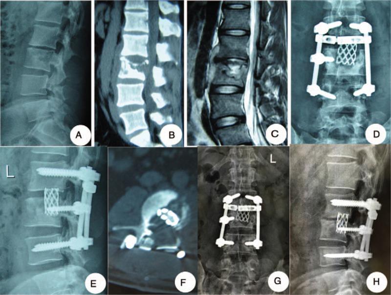 https://cdn.ncbi.nlm.nih.gov/pmc/blobs/c67a/5690773/0b0acb16ce20/medi-96-e8574-g002.jpg
