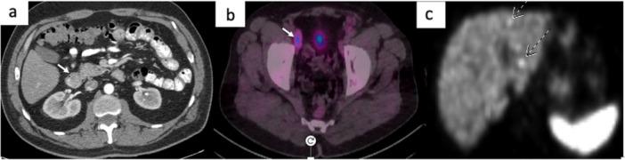 https://cdn.ncbi.nlm.nih.gov/pmc/blobs/c6db/12186107/ec64a1d71e4d/JSO-131-1336-g001.jpg