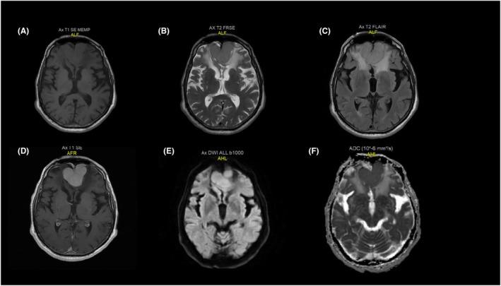 https://cdn.ncbi.nlm.nih.gov/pmc/blobs/c6f9/11166549/77c7006a6a47/CCR3-12-e9053-g001.jpg