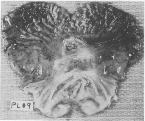 https://cdn.ncbi.nlm.nih.gov/pmc/blobs/c724/1345191/5b195411c10c/annsurg00209-0044-b.jpg