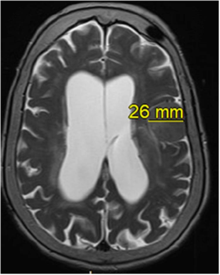 https://cdn.ncbi.nlm.nih.gov/pmc/blobs/c738/10247292/76a116c63d71/cureus-0015-00000038739-i03.jpg