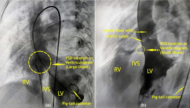 https://cdn.ncbi.nlm.nih.gov/pmc/blobs/c78c/9858716/9142c8d05928/cureus-0015-00000033942-i01.jpg