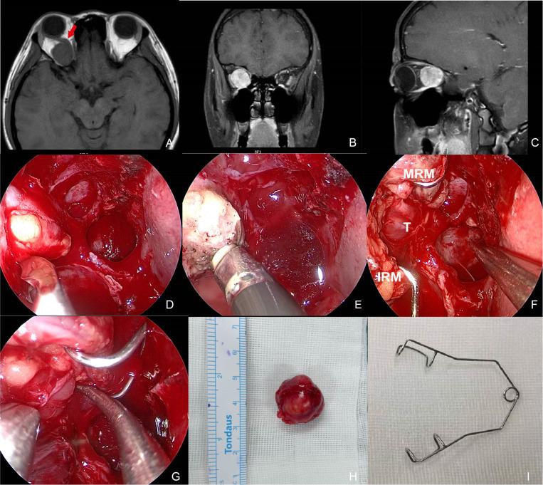 https://cdn.ncbi.nlm.nih.gov/pmc/blobs/c79e/9334750/6f7828457452/fsurg-09-923712-g002.jpg