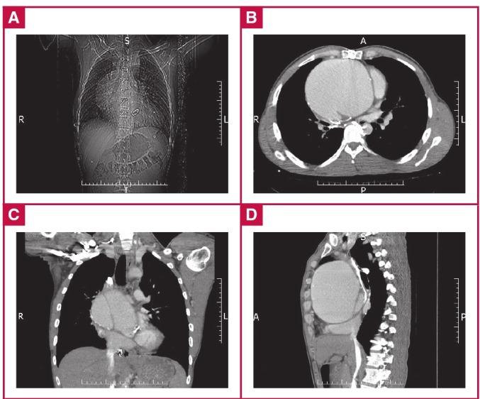 https://cdn.ncbi.nlm.nih.gov/pmc/blobs/c7f2/5646189/61e204276a33/cvja-28-e6-g001.jpg