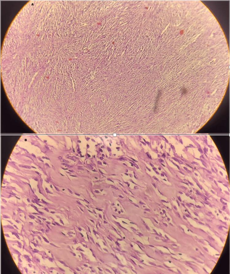 https://cdn.ncbi.nlm.nih.gov/pmc/blobs/c802/11736673/430aef0e2e46/cureus-0016-00000075856-i05.jpg