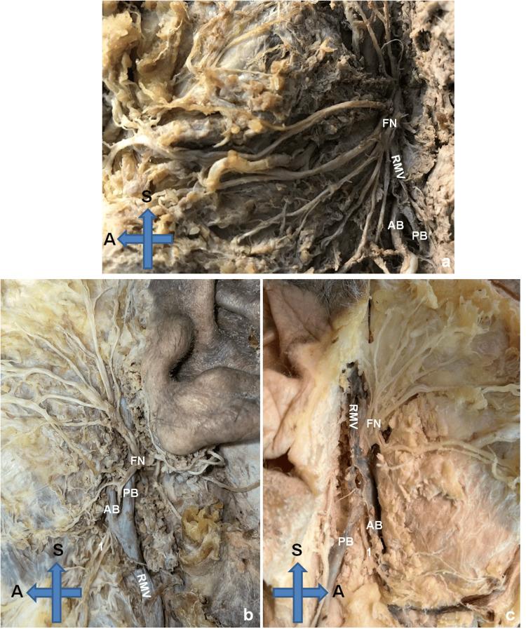 https://cdn.ncbi.nlm.nih.gov/pmc/blobs/c840/11146465/45b54519fcc8/cureus-0016-00000059637-i02.jpg