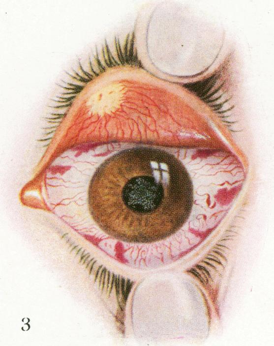 https://cdn.ncbi.nlm.nih.gov/pmc/blobs/c876/1998390/56b301555706/procrsmed00635-0093-c.jpg