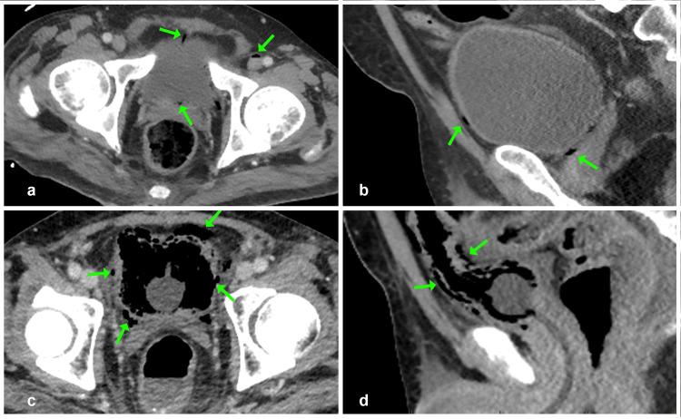 https://cdn.ncbi.nlm.nih.gov/pmc/blobs/c87f/12085309/5798d1059a0b/cureus-0017-00000082417-i01.jpg