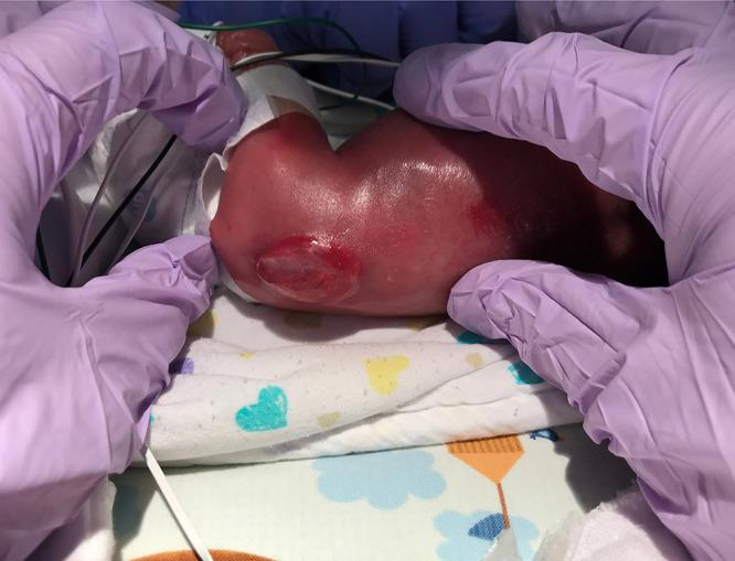 https://cdn.ncbi.nlm.nih.gov/pmc/blobs/c8aa/10916853/793ee2cd83a9/CASE23556f1.jpg