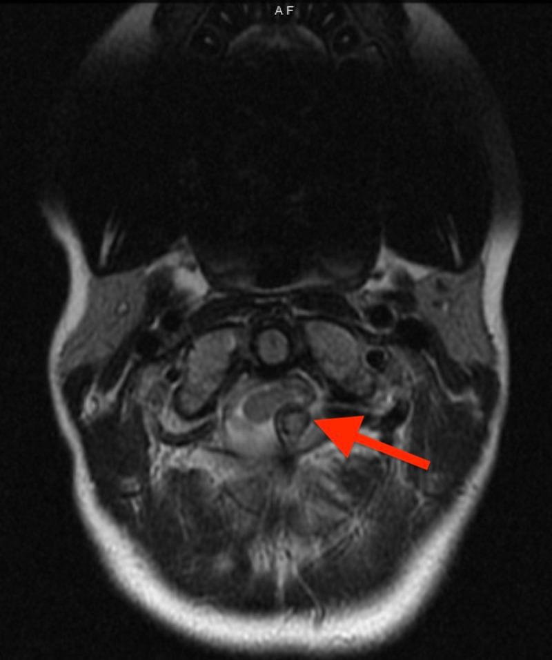 https://cdn.ncbi.nlm.nih.gov/pmc/blobs/c921/6975245/d6df51473b1b/cureus-0011-00000006452-i01.jpg
