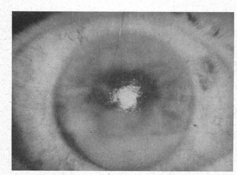 https://cdn.ncbi.nlm.nih.gov/pmc/blobs/c999/510194/74a4b0e17503/brjopthal00413-0026-a.jpg