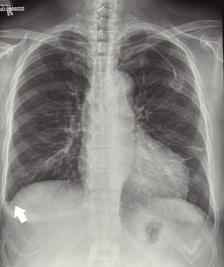 https://cdn.ncbi.nlm.nih.gov/pmc/blobs/ca27/10357392/a7fc773904af/cureus-0015-00000040675-i02.jpg