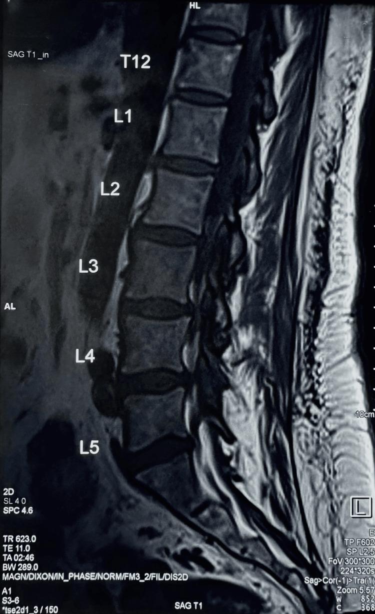 https://cdn.ncbi.nlm.nih.gov/pmc/blobs/ca27/10357392/ae342f175a83/cureus-0015-00000040675-i03.jpg