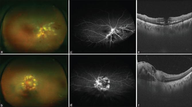 https://cdn.ncbi.nlm.nih.gov/pmc/blobs/ca7b/5678310/346435653c52/IJO-65-1038-g001.jpg