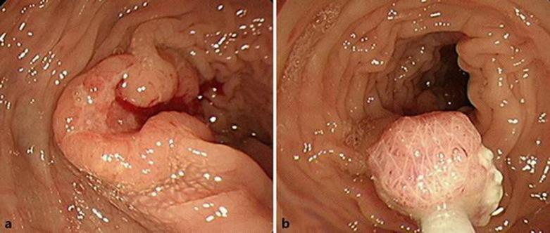 https://cdn.ncbi.nlm.nih.gov/pmc/blobs/ca93/5156887/4a1d169ec860/cro-0009-0752-g02.jpg