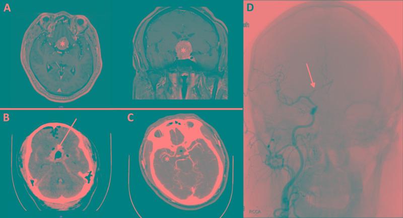 https://cdn.ncbi.nlm.nih.gov/pmc/blobs/ca9e/7299537/d169d2fdbd73/cureus-0012-00000008171-i02.jpg