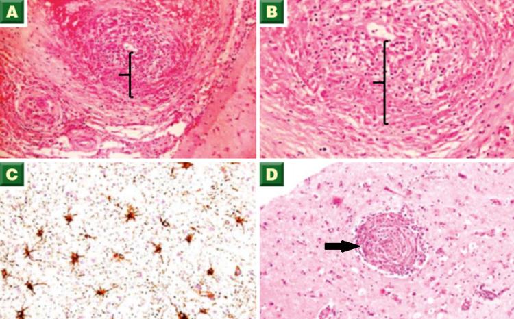 https://cdn.ncbi.nlm.nih.gov/pmc/blobs/cada/8038648/64fea42f6328/cureus-0013-00000013847-i03.jpg