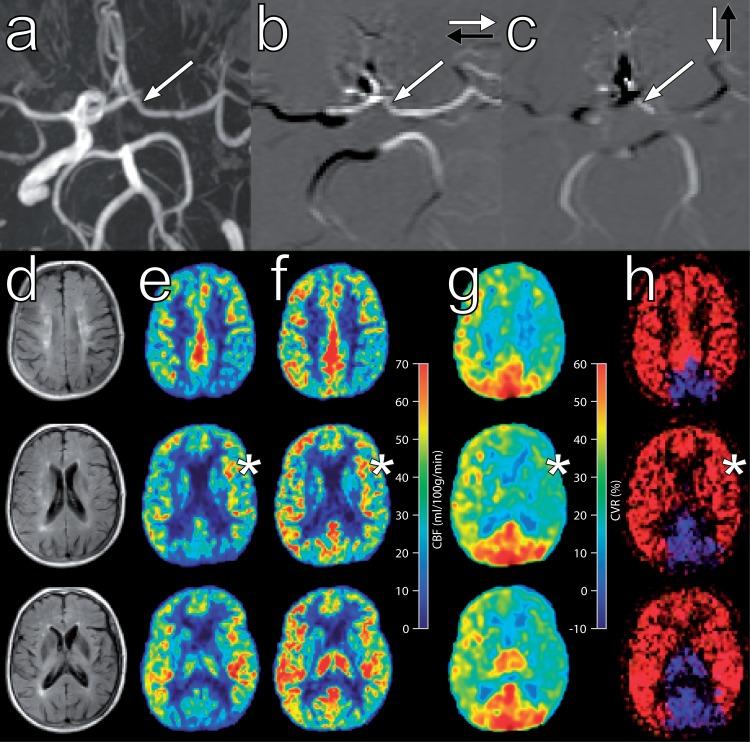 https://cdn.ncbi.nlm.nih.gov/pmc/blobs/cadc/6259314/c8abf4408e19/10.1177_0271678X17724027-fig3.jpg