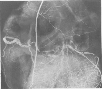 https://cdn.ncbi.nlm.nih.gov/pmc/blobs/cae2/1277311/c82d195ea514/brheartj00096-0056-a.jpg