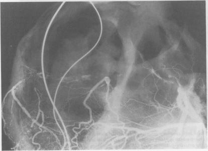 https://cdn.ncbi.nlm.nih.gov/pmc/blobs/cae2/1277311/ea76a77d28db/brheartj00096-0056-b.jpg