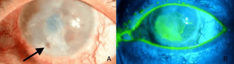 https://cdn.ncbi.nlm.nih.gov/pmc/blobs/cae4/10912818/b42a8f2c274d/cureus-0016-00000055471-i01.jpg
