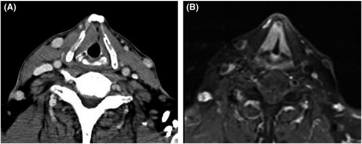 https://cdn.ncbi.nlm.nih.gov/pmc/blobs/cb25/8283844/cc6ca6f66aad/CCR3-9-e04493-g006.jpg