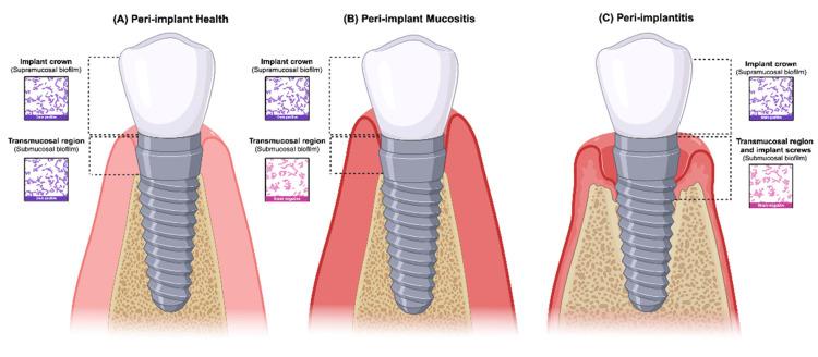 https://cdn.ncbi.nlm.nih.gov/pmc/blobs/cb48/11506630/91c52feac86d/dentistry-12-00299-g001.jpg