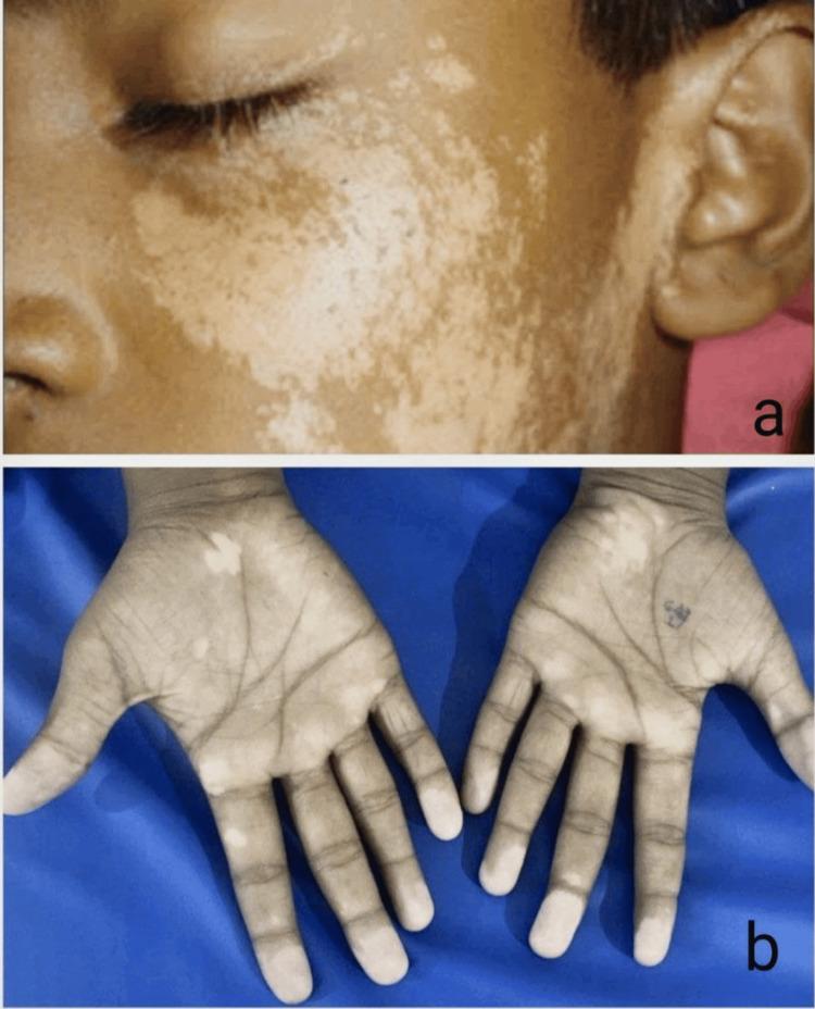 https://cdn.ncbi.nlm.nih.gov/pmc/blobs/cb59/12327571/30341c44903e/cureus-0017-00000087452-i04.jpg