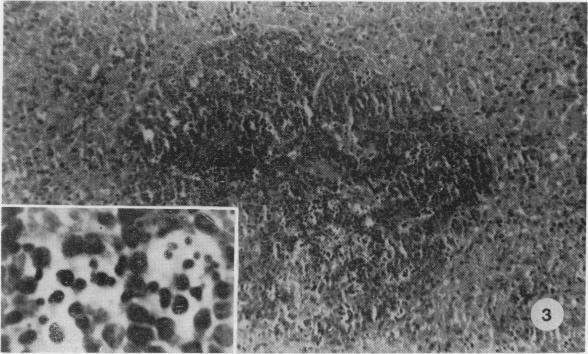 https://cdn.ncbi.nlm.nih.gov/pmc/blobs/cb59/2040808/e03b20d94a78/brjexppathol00101-0044-c.jpg