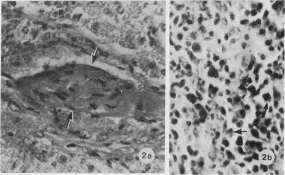 https://cdn.ncbi.nlm.nih.gov/pmc/blobs/cb59/2040808/e229ea9ad071/brjexppathol00101-0044-b.jpg