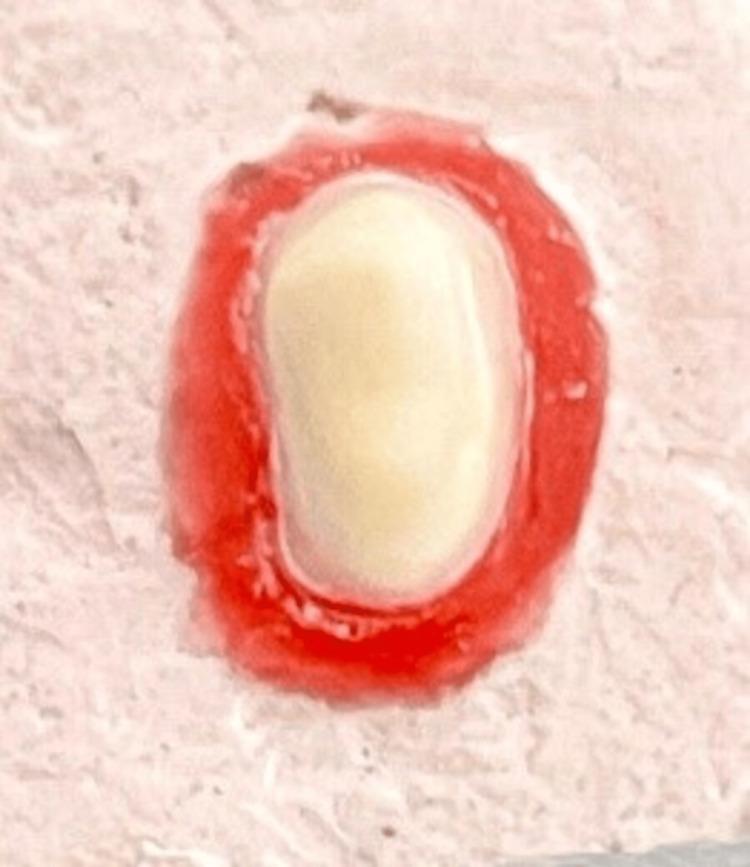 https://cdn.ncbi.nlm.nih.gov/pmc/blobs/cb90/10264088/1be716298e72/cureus-0015-00000039009-i04.jpg