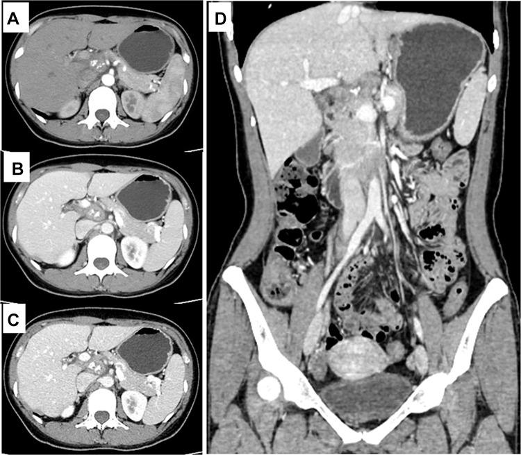 https://cdn.ncbi.nlm.nih.gov/pmc/blobs/cbaf/7719304/b1fd8a2486e2/IJGM-13-1335-g0002.jpg